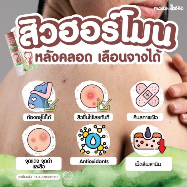 เจลทาป้องกันสิว